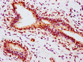 IHC image of CSB-RA007830A118phHU diluted at 1:100 and staining in paraffin-embedded human breast cancer performed on a Leica BondTM system. After dewaxing and hydration, antigen retrieval was mediated by high pressure in a citrate buffer (pH 6.0) . Section was blocked with 10% normal goat serum 30min at RT. Then primary antibody (1% BSA) was incubated at 4℃ overnight. The primary is detected by a biotinylated secondary antibody and visualized using an HRP conjugated SP system.