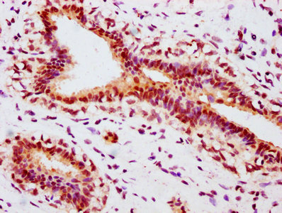 IHC image of CSB-RA007830A118phHU diluted at 1:100 and staining in paraffin-embedded human breast cancer performed on a Leica BondTM system. After dewaxing and hydration, antigen retrieval was mediated by high pressure in a citrate buffer (pH 6.0) . Section was blocked with 10% normal goat serum 30min at RT. Then primary antibody (1% BSA) was incubated at 4℃ overnight. The primary is detected by a biotinylated secondary antibody and visualized using an HRP conjugated SP system.