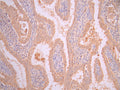 IHC image of CSB-RA008424MA2HU diluted at 1:50 and staining in paraffin-embedded human endometrial cancer performed on a Leica BondTM system. After dewaxing and hydration, antigen retrieval was mediated by high pressure in a citrate buffer (pH 6.0). Section was blocked with 10% normal goat serum 30min at RT. Then primary antibody (1% BSA) was incubated at 4°C overnight. The primary is detected by a Anti-Human lgG, Fcy Fragment Specific labeled by HRP and visualized using 0.05% DAB.