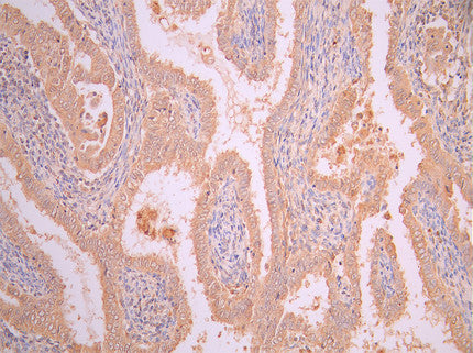 IHC image of CSB-RA008424MA2HU diluted at 1:50 and staining in paraffin-embedded human endometrial cancer performed on a Leica BondTM system. After dewaxing and hydration, antigen retrieval was mediated by high pressure in a citrate buffer (pH 6.0). Section was blocked with 10% normal goat serum 30min at RT. Then primary antibody (1% BSA) was incubated at 4°C overnight. The primary is detected by a Anti-Human lgG, Fcy Fragment Specific labeled by HRP and visualized using 0.05% DAB.
