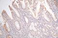 IHC image of CSB-RA009452MA1HU diluted at 1:100 and staining in paraffin-embedded human gastric cancer performed on a Leica BondTM system. After dewaxing and hydration,  antigen retrieval was mediated by high pressure in a citrate buffer (pH 6.0) . Section was blocked with 10% normal goat serum 30min at RT. Then primary antibody (1% BSA) was incubated at 4°C overnight. The primary is detected by a Goat anti-Mouse IgG labeled by HRP and visualized using 0.05% DAB.