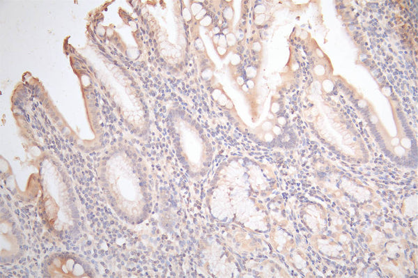 IHC image of CSB-RA009452MA1HU diluted at 1:100 and staining in paraffin-embedded human gastric cancer performed on a Leica BondTM system. After dewaxing and hydration,  antigen retrieval was mediated by high pressure in a citrate buffer (pH 6.0) . Section was blocked with 10% normal goat serum 30min at RT. Then primary antibody (1% BSA) was incubated at 4°C overnight. The primary is detected by a Goat anti-Mouse IgG labeled by HRP and visualized using 0.05% DAB.