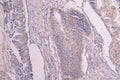 IHC image of CSB-RA009892MA1HU diluted at 1：100 and staining in paraffin-embedded human colon cancer performed on a Leica BondTM system. After dewaxing and hydration, antigen retrieval was mediated by high pressure in a citrate buffer (pH 6.0) . Section was blocked with 10% normal goat serum 30min at RT. Then primary antibody (1% BSA) was incubated at 4°C overnight. The primary is detected by a Goat anti-human polymer IgG labeled by HRP and visualized using 0.05% DAB.