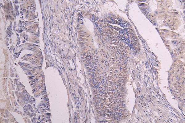 IHC image of CSB-RA009892MA1HU diluted at 1：100 and staining in paraffin-embedded human colon cancer performed on a Leica BondTM system. After dewaxing and hydration, antigen retrieval was mediated by high pressure in a citrate buffer (pH 6.0) . Section was blocked with 10% normal goat serum 30min at RT. Then primary antibody (1% BSA) was incubated at 4°C overnight. The primary is detected by a Goat anti-human polymer IgG labeled by HRP and visualized using 0.05% DAB.