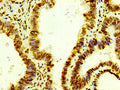 IHC image of CSB-RA010429A0HU diluted at 1:100 and staining in paraffin-embedded human colon cancer performed on a Leica BondTM system. After dewaxing and hydration, antigen retrieval was mediated by high pressure in a citrate buffer (pH 6.0) . Section was blocked with 10% normal goat serum 30min at RT. Then primary antibody (1% BSA) was incubated at 4℃ overnight. The primary is detected by a biotinylated secondary antibody and visualized using an HRP conjugated SP system.