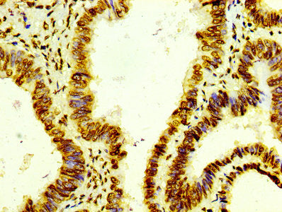 IHC image of CSB-RA010429A0HU diluted at 1:100 and staining in paraffin-embedded human colon cancer performed on a Leica BondTM system. After dewaxing and hydration, antigen retrieval was mediated by high pressure in a citrate buffer (pH 6.0) . Section was blocked with 10% normal goat serum 30min at RT. Then primary antibody (1% BSA) was incubated at 4℃ overnight. The primary is detected by a biotinylated secondary antibody and visualized using an HRP conjugated SP system.