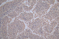 IHC image of CSB-RA010833MA1HU diluted at 1:100 and staining in paraffin-embedded human cervical cancer performed on a Leica BondTM system. After dewaxing and hydration,  antigen retrieval was mediated by high pressure in a citrate buffer (pH 6.0) . Section was blocked with 10% normal goat serum 30min at RT. Then primary antibody (1% BSA) was incubated at 4°C overnight. The primary is detected by a Goat anti-Mouse IgG labeled by HRP and visualized using 0.05% DAB.