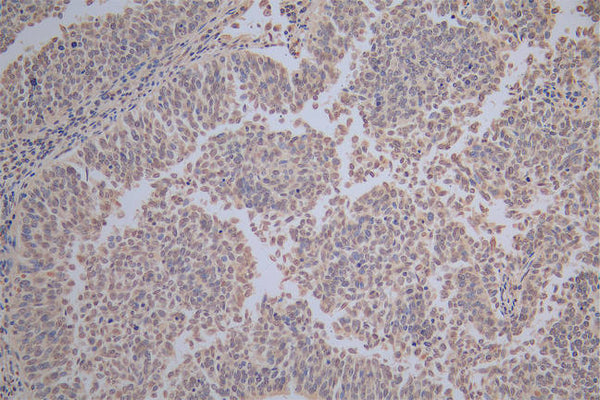 IHC image of CSB-RA010833MA1HU diluted at 1:100 and staining in paraffin-embedded human cervical cancer performed on a Leica BondTM system. After dewaxing and hydration,  antigen retrieval was mediated by high pressure in a citrate buffer (pH 6.0) . Section was blocked with 10% normal goat serum 30min at RT. Then primary antibody (1% BSA) was incubated at 4°C overnight. The primary is detected by a Goat anti-Mouse IgG labeled by HRP and visualized using 0.05% DAB.