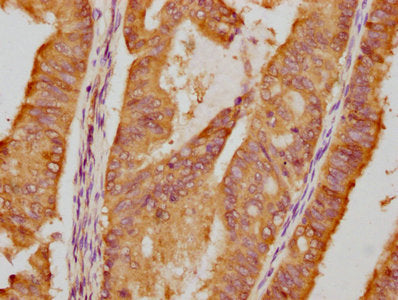 IHC image of CSB-RA011087A1HU diluted at 1:87.5 and staining in paraffin-embedded human endometrial cancer performed on a Leica BondTM system. After dewaxing and hydration, antigen retrieval was mediated by high pressure in a citrate buffer (pH 6.0) . Section was blocked with 10% normal goat serum 30min at RT. Then primary antibody (1% BSA) was incubated at 4℃ overnight. The primary is detected by a biotinylated secondary antibody and visualized using an HRP conjugated SP system.