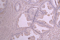 IHC image of CSB-RA011586MA1HU diluted at 1：50 and staining in paraffin-embedded human prostate cancer performed on a Leica BondTM system. After dewaxing and hydration, antigen retrieval was mediated by high pressure in a citrate buffer (pH 6.0) . Section was blocked with 10% normal goat serum 30min at RT. Then primary antibody (1% BSA) was incubated at 4°C overnight. The primary is detected by a Goat anti-human polymer IgG labeled by HRP and visualized using 0.05% DAB.