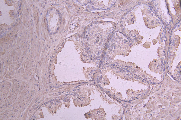 IHC image of CSB-RA011586MA1HU diluted at 1：50 and staining in paraffin-embedded human prostate cancer performed on a Leica BondTM system. After dewaxing and hydration, antigen retrieval was mediated by high pressure in a citrate buffer (pH 6.0) . Section was blocked with 10% normal goat serum 30min at RT. Then primary antibody (1% BSA) was incubated at 4°C overnight. The primary is detected by a Goat anti-human polymer IgG labeled by HRP and visualized using 0.05% DAB.