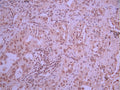IHC image of CSB-RA012285A0HU diluted at 1:100 and staining in paraffin-embedded human lung cancer performed on a Leica BondTM system. After dewaxing and hydration, antigen retrieval was mediated by high pressure in a citrate buffer (pH 6.0). Section was blocked with 10% normal goat serum 30min at RT. Then primary antibody (1% BSA) was incubated at 4°C overnight. The primary is detected by a Goat anti-rabbit polymer IgG labeled by HRP and visualized using 0.05% DAB.