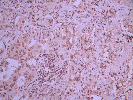 IHC image of CSB-RA012285A0HU diluted at 1:100 and staining in paraffin-embedded human lung cancer performed on a Leica BondTM system. After dewaxing and hydration, antigen retrieval was mediated by high pressure in a citrate buffer (pH 6.0). Section was blocked with 10% normal goat serum 30min at RT. Then primary antibody (1% BSA) was incubated at 4°C overnight. The primary is detected by a Goat anti-rabbit polymer IgG labeled by HRP and visualized using 0.05% DAB.