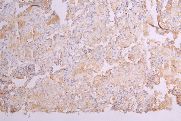 IHC image of CSB-RA012352MA1HU diluted at 1：100 and staining in paraffin-embedded human lung tissue performed on a Leica BondTM system. After dewaxing and hydration, antigen retrieval was mediated by high pressure in a citrate buffer (pH 6.0) . Section was blocked with 10% normal goat serum 30min at RT. Then primary antibody (1% BSA) was incubated at 4°C overnight. The primary is detected by a Goat anti-human polymer IgG labeled by HRP and visualized using 0.05% DAB.