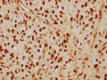 IHC image of CSB-RA013003A0HU diluted at 1:115 and staining in paraffin-embedded human glioma cancer performed on a Leica BondTM system. After dewaxing and hydration, antigen retrieval was mediated by high pressure in a citrate buffer (pH 6.0) . Section was blocked with 10% normal goat serum 30min at RT. Then primary antibody (1% BSA) was incubated at 4℃ overnight. The primary is detected by a biotinylated secondary antibody and visualized using an HRP conjugated SP system.