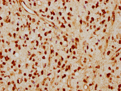IHC image of CSB-RA013003A0HU diluted at 1:115 and staining in paraffin-embedded human glioma cancer performed on a Leica BondTM system. After dewaxing and hydration, antigen retrieval was mediated by high pressure in a citrate buffer (pH 6.0) . Section was blocked with 10% normal goat serum 30min at RT. Then primary antibody (1% BSA) was incubated at 4℃ overnight. The primary is detected by a biotinylated secondary antibody and visualized using an HRP conjugated SP system.