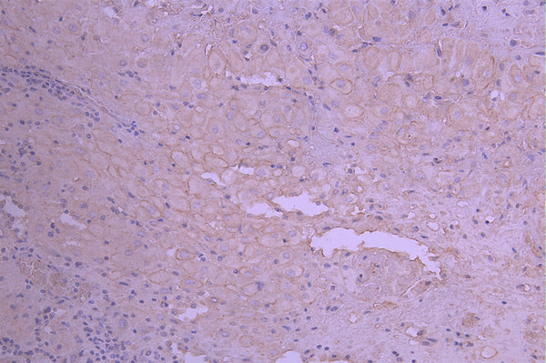 IHC image of CSB-RA014666MA1HU diluted at 1：50 and staining in paraffin-embedded human placenta tissue performed on a Leica BondTM system. After dewaxing and hydration, antigen retrieval was mediated by high pressure in a citrate buffer (pH 6.0) . Section was blocked with 10% normal goat serum 30min at RT. Then primary antibody (1% BSA) was incubated at 4°C overnight. The primary is detected by a Anti-Human lgG, Fcy Fragment Specific labeled by HRP and visualized using 0.05% DAB.