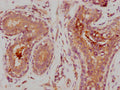 IHC image of CSB-RA014679A0HU diluted at 1:235 and staining in paraffin-embedded human breast cancer performed on a Leica BondTM system. After dewaxing and hydration, antigen retrieval was mediated by high pressure in a citrate buffer (pH 6.0) . Section was blocked with 10% normal goat serum 30min at RT. Then primary antibody (1% BSA) was incubated at 4℃ overnight. The primary is detected by a biotinylated secondary antibody and visualized using an HRP conjugated SP system.