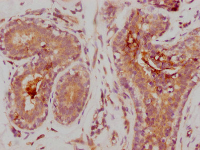 IHC image of CSB-RA014679A0HU diluted at 1:235 and staining in paraffin-embedded human breast cancer performed on a Leica BondTM system. After dewaxing and hydration, antigen retrieval was mediated by high pressure in a citrate buffer (pH 6.0) . Section was blocked with 10% normal goat serum 30min at RT. Then primary antibody (1% BSA) was incubated at 4℃ overnight. The primary is detected by a biotinylated secondary antibody and visualized using an HRP conjugated SP system.