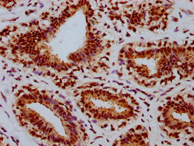 IHC image of CSB-RA019386A780phHU diluted at 1:100 and staining in paraffin-embedded human breast cancer performed on a Leica BondTM system. After dewaxing and hydration, antigen retrieval was mediated by high pressure in a citrate buffer (pH 6.0) . Section was blocked with 10% normal goat serum 30min at RT. Then primary antibody (1% BSA) was incubated at 4℃ overnight. The primary is detected by a biotinylated secondary antibody and visualized using an HRP conjugated SP system.