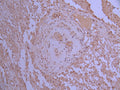 IHC image of CSB-RA020728A0HU diluted at 1:100 and staining in paraffin-embedded human glioma cancer performed on a Leica BondTM system. After dewaxing and hydration, antigen retrieval was mediated by high pressure in a citrate buffer (pH 6.0) . Section was blocked with 10% normal goat serum 30min at RT. Then primary antibody (1% BSA) was incubated at 4°C overnight. The primary is detected by a Goat anti-rabbit polymer IgG labeled by HRP and visualized using 0.05% DAB.