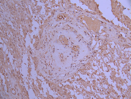 IHC image of CSB-RA020728A0HU diluted at 1:100 and staining in paraffin-embedded human glioma cancer performed on a Leica BondTM system. After dewaxing and hydration, antigen retrieval was mediated by high pressure in a citrate buffer (pH 6.0) . Section was blocked with 10% normal goat serum 30min at RT. Then primary antibody (1% BSA) was incubated at 4°C overnight. The primary is detected by a Goat anti-rabbit polymer IgG labeled by HRP and visualized using 0.05% DAB.