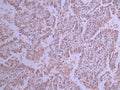 IHC image of CSB-RA021503A0HU diluted at 1:100 and staining in paraffin-embedded human lung cancer performed on a Leica BondTM system. After dewaxing and hydration, antigen retrieval was mediated by high pressure in a citrate buffer (pH 6.0) . Section was blocked with 10% normal goat serum 30min at RT. Then primary antibody (1% BSA) was incubated at 4°C overnight. The primary is detected by a Goat anti-rabbit polymer IgG labeled by HRP and visualized using 0.05% DAB.