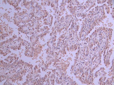 IHC image of CSB-RA021503A0HU diluted at 1:100 and staining in paraffin-embedded human lung cancer performed on a Leica BondTM system. After dewaxing and hydration, antigen retrieval was mediated by high pressure in a citrate buffer (pH 6.0) . Section was blocked with 10% normal goat serum 30min at RT. Then primary antibody (1% BSA) was incubated at 4°C overnight. The primary is detected by a Goat anti-rabbit polymer IgG labeled by HRP and visualized using 0.05% DAB.