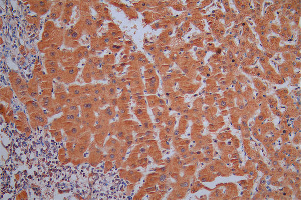 IHC image of CSB-RA021915MA1HU diluted at 1:50 and staining in paraffin-embedded human liver cancer performed on a Leica BondTM system. After dewaxing and hydration,  antigen retrieval was mediated by high pressure in a citrate buffer (pH 6.0) . Section was blocked with 10% normal goat serum 30min at RT. Then primary antibody (1% BSA) was incubated at 4°C overnight. The primary is detected by a Goat anti-Mouse IgG labeled by HRP and visualized using 0.05% DAB.
