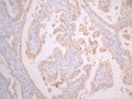 IHC image of CSB-RA023072MA4HU diluted at 1:50 and staining in paraffin-embedded human cervical cancer performed on a Leica BondTM system. After dewaxing and hydration, antigen retrieval was mediated by high pressure in a citrate buffer (pH 6.0). Section was blocked with 10% normal goat serum 30min at RT. Then primary antibody (1% BSA) was incubated at 4°C overnight. The primary is detected by a Goat anti-mouse polymer IgG labeled by HRP and visualized using 0.05% DAB.