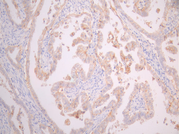 IHC image of CSB-RA023072MA4HU diluted at 1:50 and staining in paraffin-embedded human cervical cancer performed on a Leica BondTM system. After dewaxing and hydration, antigen retrieval was mediated by high pressure in a citrate buffer (pH 6.0). Section was blocked with 10% normal goat serum 30min at RT. Then primary antibody (1% BSA) was incubated at 4°C overnight. The primary is detected by a Goat anti-mouse polymer IgG labeled by HRP and visualized using 0.05% DAB.