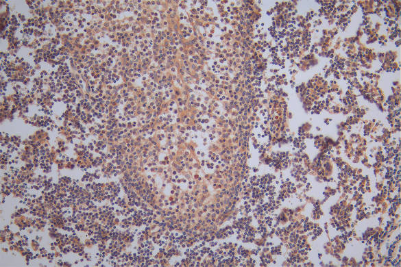 IHC image of CSB-RA008642MA1HU diluted at 1:50 and staining in paraffin-embedded human tonsil tissue performed on a Leica BondTM system. After dewaxing and hydration,  antigen retrieval was mediated by high pressure in a citrate buffer (pH 6.0) . Section was blocked with 10% normal goat serum 30min at RT. Then primary antibody (1% BSA) was incubated at 4°C overnight. The primary is detected by a Goat anti-Rabbit IgG labeled by HRP and visualized using 0.05% DAB.