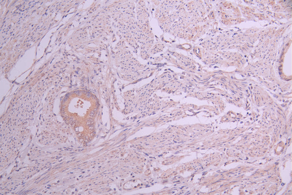 IHC image of CSB-RA023954MA1HU diluted at 1:50 and staining in paraffin-embedded human cervical cancer performed on a Leica BondTM system. After dewaxing and hydration, antigen retrieval was mediated by high pressure in a citrate buffer (pH 6.0) . Section was blocked with 10% normal goat serum 30min at RT. Then primary antibody (1% BSA) was incubated at 4°C overnight. The primary is detected by a Anti-Human lgG, Fcy Fragment Specific labeled by HRP and visualized using 0.05% DAB.