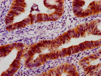 IHC image of CSB-RA024077A33phHU diluted at 1:100 and staining in paraffin-embedded human colon cancer performed on a Leica BondTM system. After dewaxing and hydration, antigen retrieval was mediated by high pressure in a citrate buffer (pH 6.0) . Section was blocked with 10% normal goat serum 30min at RT. Then primary antibody (1% BSA) was incubated at 4℃ overnight. The primary is detected by a biotinylated secondary antibody and visualized using an HRP conjugated SP system.