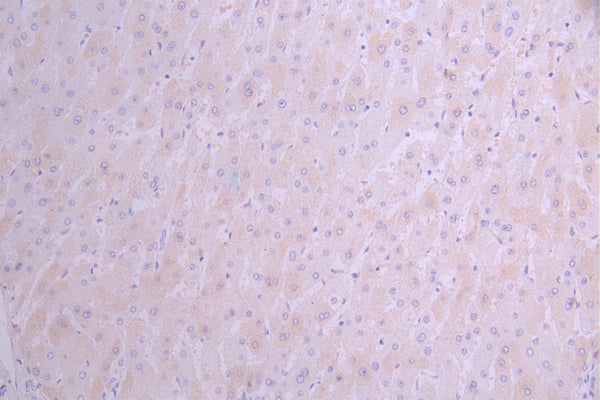 IHC image of CSB-RA025267MA1HU diluted at 1:50 and staining in paraffin-embedded human liver cancer performed on a Leica BondTM system. After dewaxing and hydration, antigen retrieval was mediated by high pressure in a citrate buffer (pH 6.0) . Section was blocked with 10% normal goat serum 30min at RT. Then primary antibody (1% BSA) was incubated at 4°C overnight. The primary is detected by a Anti-Human lgG, Fcy Fragment Specific labeled by HRP and visualized using 0.05% DAB.
