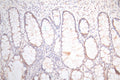 IHC image of CSB-RA025440MA1HU diluted at 1:300 and staining in paraffin-embedded human colorectal cancer performed on a Leica BondTM system. After dewaxing and hydration,  antigen retrieval was mediated by high pressure in a citrate buffer (pH 6.0) . Section was blocked with 10% normal goat serum 30min at RT. Then primary antibody (1% BSA) was incubated at 4°C overnight. The primary is detected by a Goat anti-Mouse IgG labeled by HRP and visualized using 0.05% DAB.