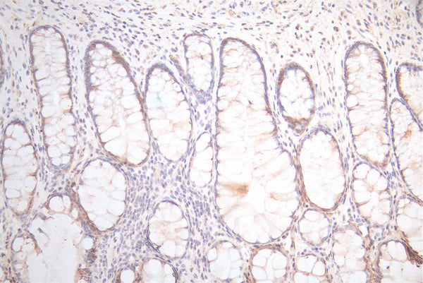 IHC image of CSB-RA025440MA1HU diluted at 1:300 and staining in paraffin-embedded human colorectal cancer performed on a Leica BondTM system. After dewaxing and hydration,  antigen retrieval was mediated by high pressure in a citrate buffer (pH 6.0) . Section was blocked with 10% normal goat serum 30min at RT. Then primary antibody (1% BSA) was incubated at 4°C overnight. The primary is detected by a Goat anti-Mouse IgG labeled by HRP and visualized using 0.05% DAB.
