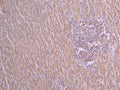 IHC image of CSB-RA025833MA1HU diluted at 1:50 and staining in paraffin-embedded human liver cancer performed on a Leica BondTM system. After dewaxing and hydration, antigen retrieval was mediated by high pressure in a citrate buffer (pH 6.0) . Section was blocked with 10% normal goat serum 30min at RT. Then primary antibody (1% BSA) was incubated at 4°C overnight. The primary is detected by a Goat anti-Rabbit IgG labeled by HRP and visualized using 0.05% DAB.
