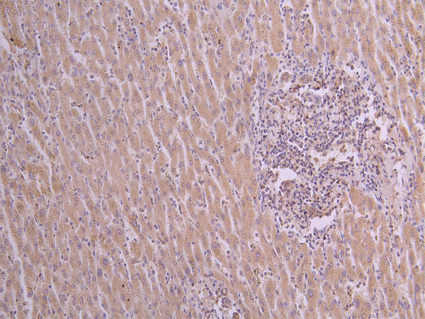 IHC image of CSB-RA025833MA1HU diluted at 1:50 and staining in paraffin-embedded human liver cancer performed on a Leica BondTM system. After dewaxing and hydration, antigen retrieval was mediated by high pressure in a citrate buffer (pH 6.0) . Section was blocked with 10% normal goat serum 30min at RT. Then primary antibody (1% BSA) was incubated at 4°C overnight. The primary is detected by a Goat anti-Rabbit IgG labeled by HRP and visualized using 0.05% DAB.