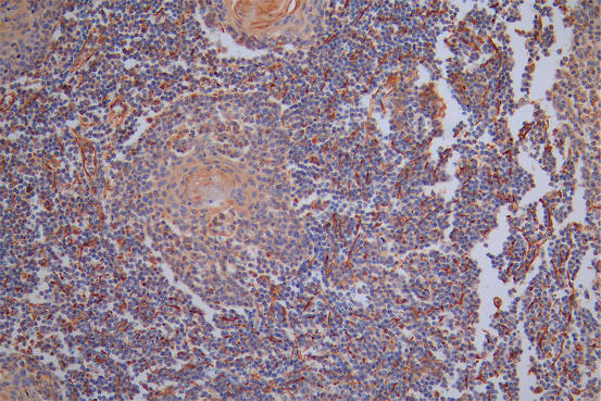 IHC image of CSB-RA025857MA1HU diluted at 1:40 and staining in paraffin-embedded human tonsil tissue performed on a Leica BondTM system. After dewaxing and hydration,  antigen retrieval was mediated by high pressure in a citrate buffer (pH 6.0) . Section was blocked with 10% normal goat serum 30min at RT. Then primary antibody (1% BSA) was incubated at 4°C overnight. The primary is detected by a Goat anti-Rabbit IgG labeled by HRP and visualized using 0.05% DAB.