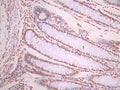 IHC image of CSB-RA025857MA2HU diluted at 1:50 and staining in paraffin-embedded human colorectal cancer performed on a Leica BondTM system. After dewaxing and hydration, antigen retrieval was mediated by high pressure in a citrate buffer (pH 6.0). Section was blocked with 10% normal goat serum 30min at RT. Then primary antibody (1% BSA) was incubated at 4°C overnight. The primary is detected by a Anti-Human lgG, Fcy Fragment Specific labeled by HRP and visualized using 0.05% DAB.
