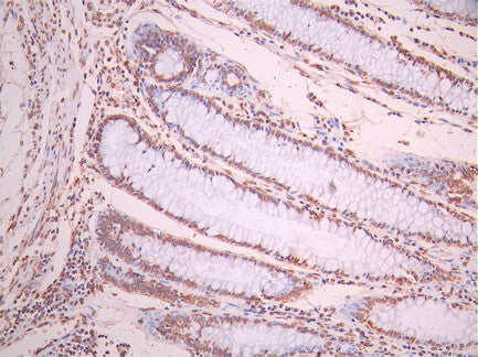 IHC image of CSB-RA025857MA2HU diluted at 1:50 and staining in paraffin-embedded human colorectal cancer performed on a Leica BondTM system. After dewaxing and hydration, antigen retrieval was mediated by high pressure in a citrate buffer (pH 6.0). Section was blocked with 10% normal goat serum 30min at RT. Then primary antibody (1% BSA) was incubated at 4°C overnight. The primary is detected by a Anti-Human lgG, Fcy Fragment Specific labeled by HRP and visualized using 0.05% DAB.