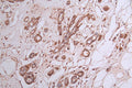 IHC image of CSB-RA029079A0HU diluted at 1:50 and staining in paraffin-embedded human breast cancer performed on a Leica BondTM system. After dewaxing and hydration, antigen retrieval was mediated by high pressure in a citrate buffer (pH 6.0) . Section was blocked with 10% normal goat serum 30min at RT. Then primary antibody (1% BSA) was incubated at 4°C overnight. The primary is detected by a Goat anti-rabbit polymer IgG labeled by HRP and visualized using 0.35% DAB.