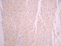 IHC image of CSB-RA030958A0HU diluted at 1:100 and staining in paraffin-embedded human liver cancer performed on a Leica BondTM system. After dewaxing and hydration, antigen retrieval was mediated by high pressure in a citrate buffer (pH 6.0). Section was blocked with 10% normal goat serum 30min at RT. Then primary antibody (1% BSA) was incubated at 4°C overnight. The primary is detected by a Goat anti-rabbit polymer IgG labeled by HRP and visualized using 0.05% DAB.