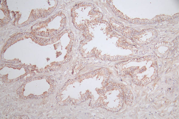 IHC image of CSB-RA037143A0HU diluted at 1:100 and staining in paraffin-embedded human prostate tissue performed on a Leica BondTM system. After dewaxing and hydration, antigen retrieval was mediated by high pressure in a citrate buffer (pH 6.0) . Section was blocked with 10% normal goat serum 30min at RT. Then primary antibody (1% BSA) was incubated at 4°C overnight. The primary is detected by a Goat anti-rabbit polymer IgG labeled by HRP and visualized using 0.77% DAB.