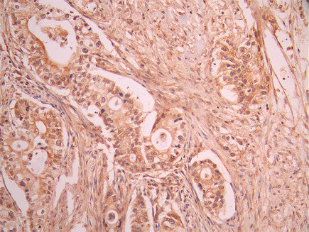 IHC image of CSB-RA037392A0HU diluted at 1:100 and staining in paraffin-embedded human pancreatic cancer performed on a Leica BondTM system. After dewaxing and hydration, antigen retrieval was mediated by high pressure in a citrate buffer (pH 6.0). Section was blocked with 10% normal goat serum 30min at RT. Then primary antibody (1% BSA) was incubated at 4°C overnight. The primary is detected by a Goat anti-rabbit polymer IgG labeled by HRP and visualized using 0.05% DAB.