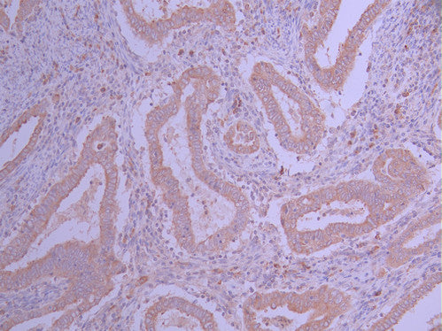 IHC image of CSB-RA039517A0HU diluted at 1:100 and staining in paraffin-embedded human endometrial cancer/endometrial carcinoma performed on a Leica BondTM system. After dewaxing and hydration, antigen retrieval was mediated by high pressure in a citrate buffer (pH 6.0) . Section was blocked with 10% normal goat serum 30min at RT. Then primary antibody (1% BSA) was incubated at 4°C overnight. The primary is detected by a Goat anti-rabbit polymer IgG labeled by HRP and visualized using 0.05% DAB.