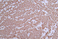 IHC image of CSB-RA042122A0HU diluted at 1:50 and staining in paraffin-embedded human liver cancer performed on a Leica BondTM system. After dewaxing and hydration, antigen retrieval was mediated by high pressure in a citrate buffer (pH 6.0) . Section was blocked with 10% normal goat serum 30min at RT. Then primary antibody (1% BSA) was incubated at 4°C overnight. The primary is detected by a Goat anti-rabbit polymer IgG labeled by HRP and visualized using 0.71% DAB.