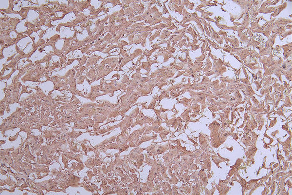 IHC image of CSB-RA042122A0HU diluted at 1:50 and staining in paraffin-embedded human liver cancer performed on a Leica BondTM system. After dewaxing and hydration, antigen retrieval was mediated by high pressure in a citrate buffer (pH 6.0) . Section was blocked with 10% normal goat serum 30min at RT. Then primary antibody (1% BSA) was incubated at 4°C overnight. The primary is detected by a Goat anti-rabbit polymer IgG labeled by HRP and visualized using 0.71% DAB.