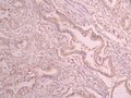 IHC image of CSB-RA044921A0HU diluted at 1:100 and staining in paraffin-embedded human cervical cancer performed on a Leica BondTM system. After dewaxing and hydration, antigen retrieval was mediated by high pressure in a citrate buffer (pH 6.0) . Section was blocked with 10% normal goat serum 30min at RT. Then primary antibody (1% BSA) was incubated at 4°C overnight. The primary is detected by a Goat anti-rabbit polymer IgG labeled by HRP and visualized using 0.05% DAB.